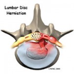p_herniatedlumbar
