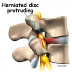 p_herniatedprotruding